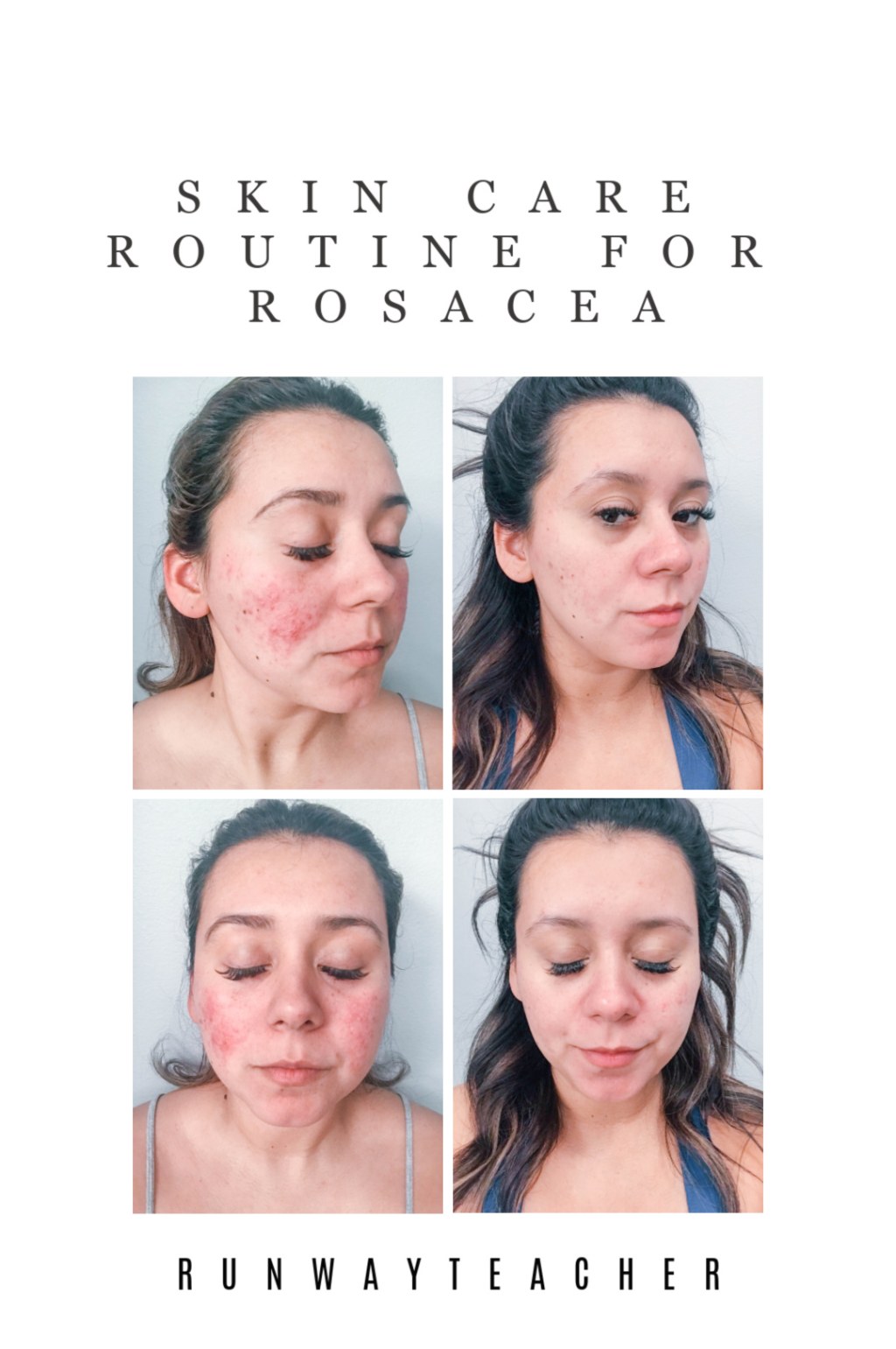 Picture of: Skin Care Routine for Rosacea